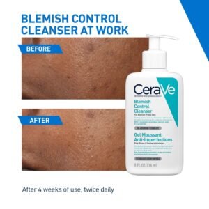 CeraVe Blemish Control Cleanser with 2% Salicylic Acid & Niacinamide for Acne Prone Skin | Controls Acne & Spots | Unclog Pores